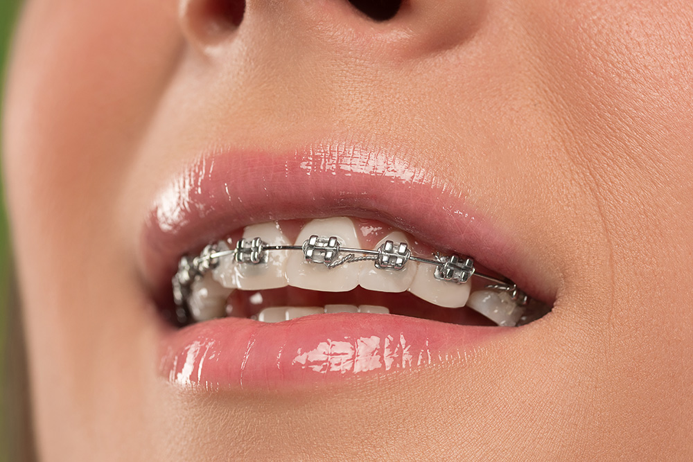 beautiful young woman with teeth braces 7PF5YKS