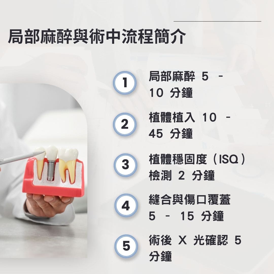 植牙要多久?植牙手術時間超過2小時嗎?植牙過程時間細節通通告訴你 2 dental implant surgery time2 1