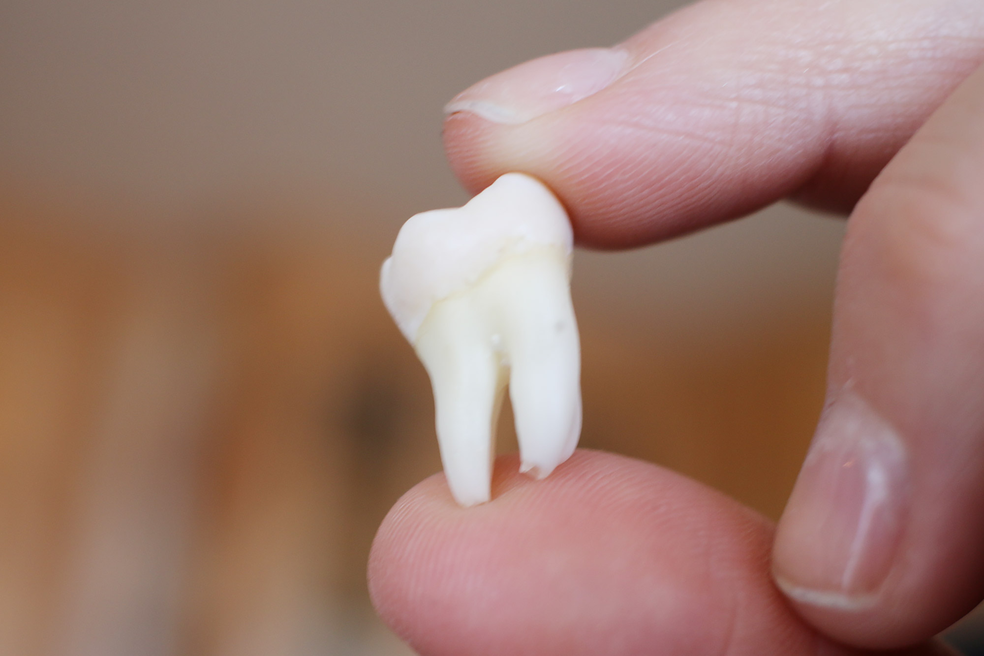 wisdom tooth