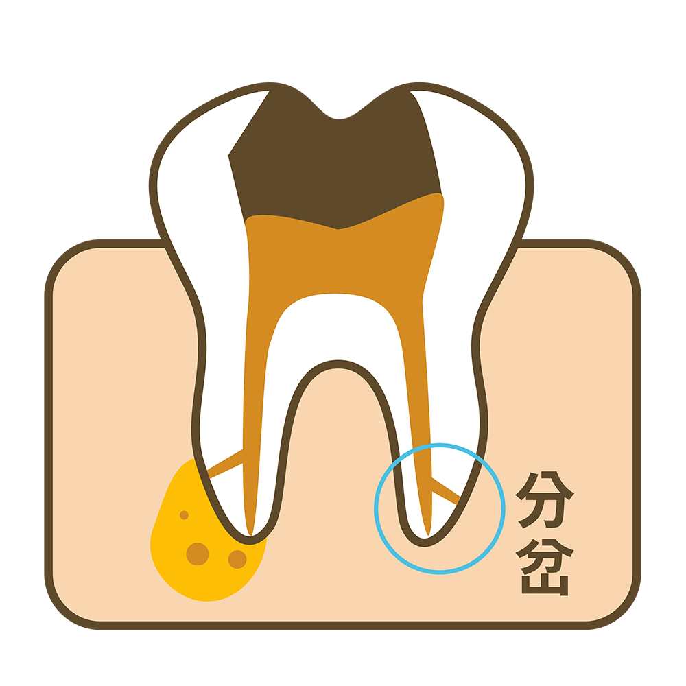 六 膿包破壞骨頭