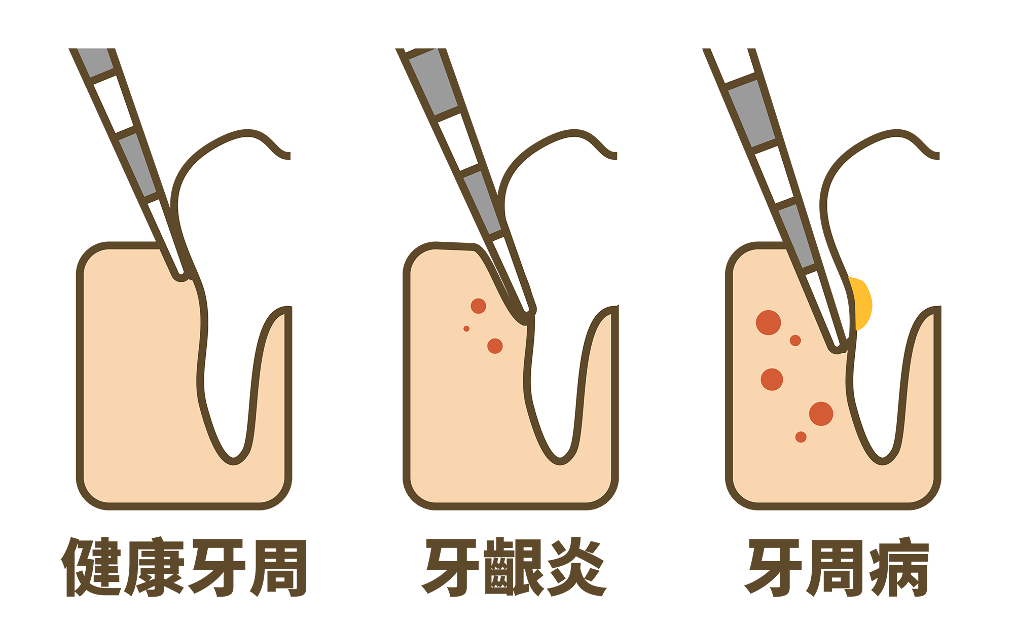 十三 牙周