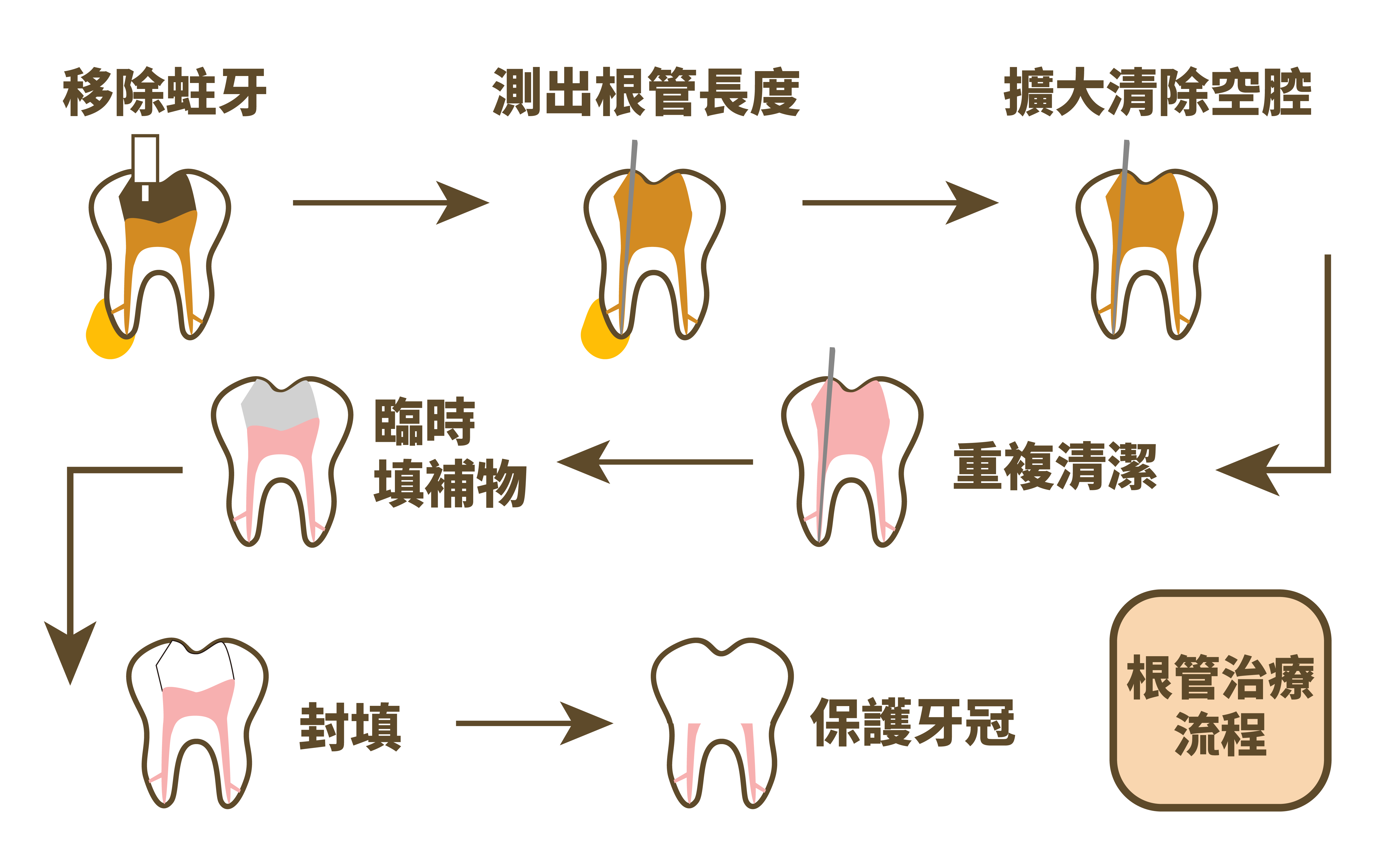 根管治療 27 根管治療流程圖