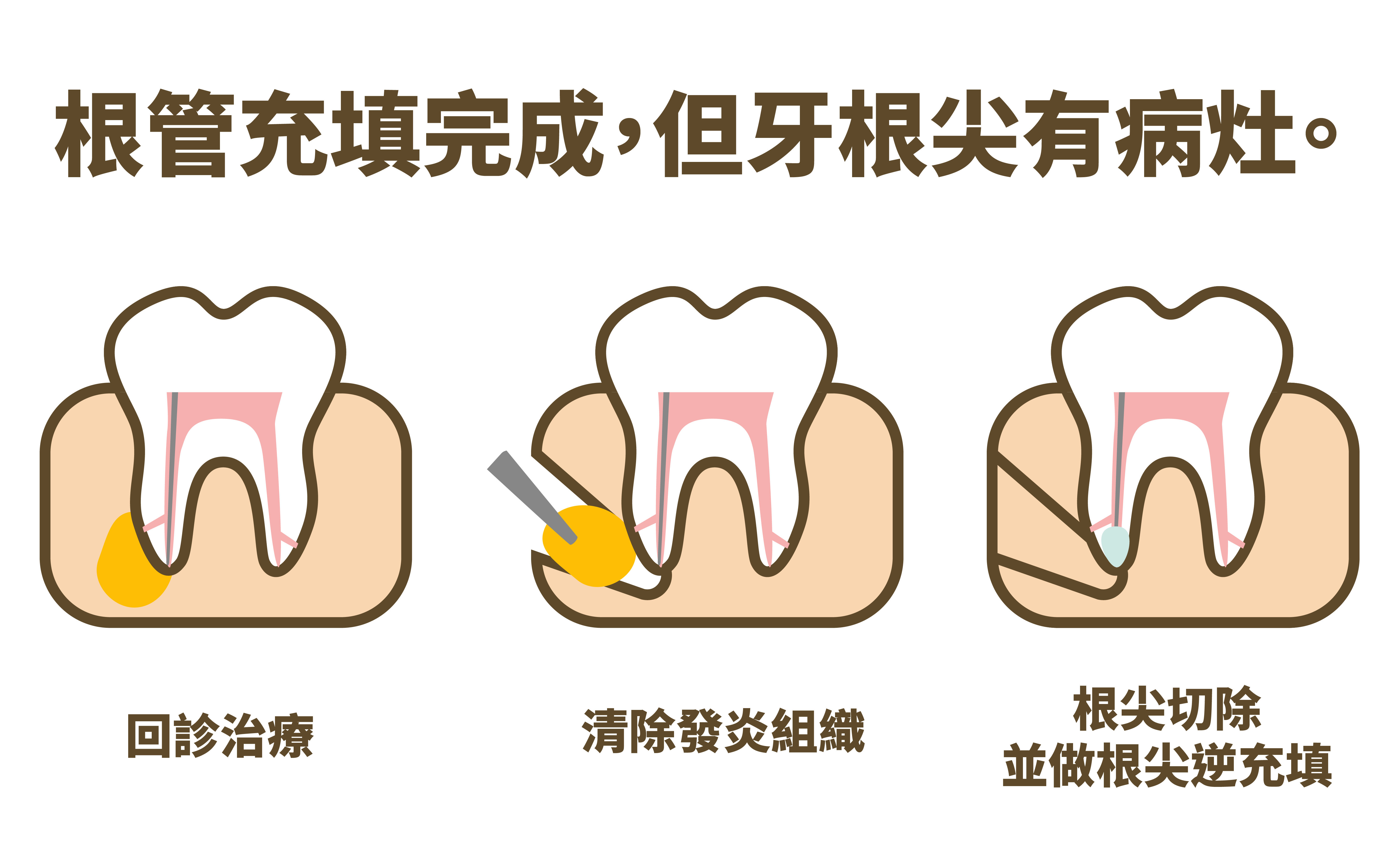 根管治療 29 根管充填完成，但牙根尖有病灶