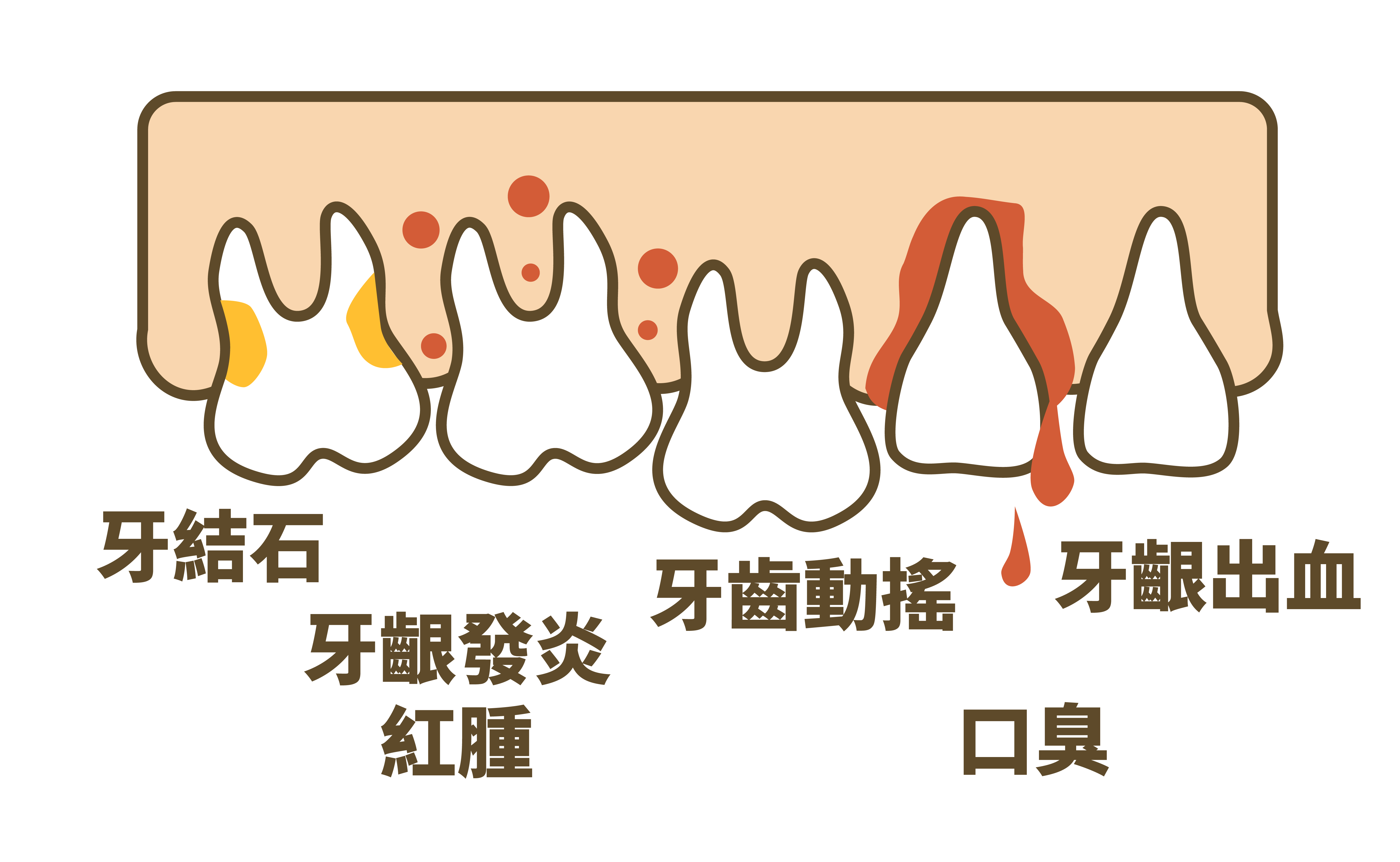 植牙與自然牙比較 19 牙周病症狀